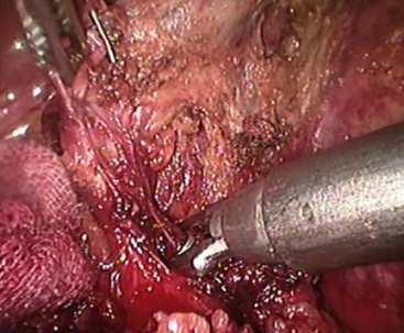 after 24 hours, Histopathological examination of gall bladder was performed for all patients. Figure 5. Applying clip to artery. Figure 6.
