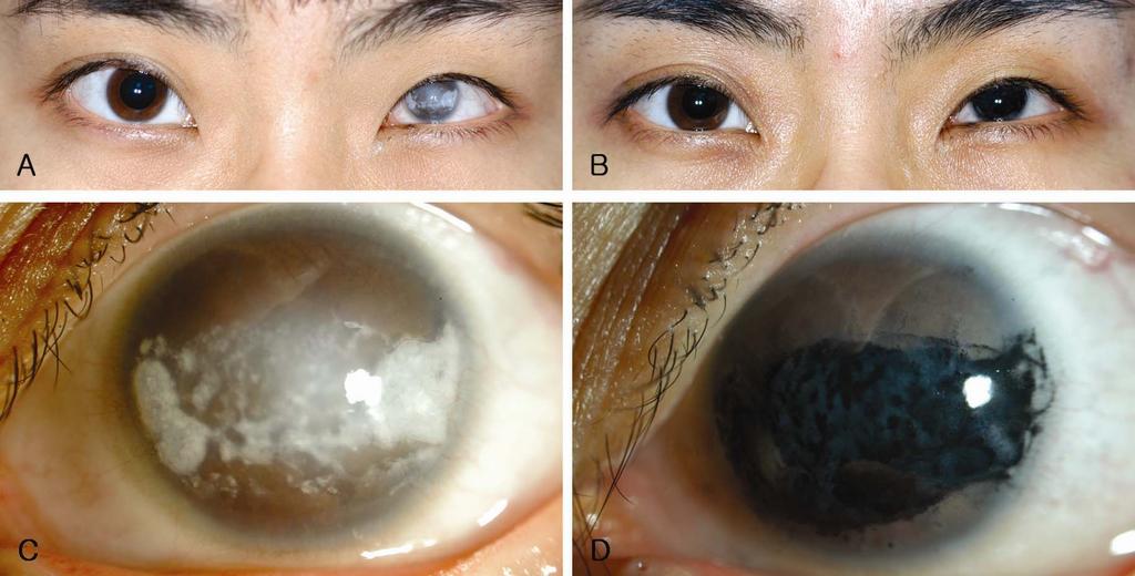 Figure 1. A 20-year-old female patient with band keratopathy in the left eye.