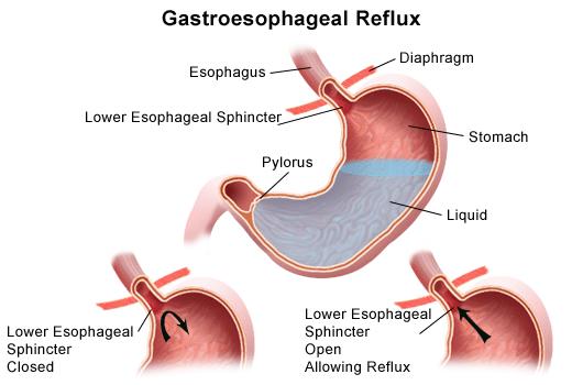 A chronic disease that occurs when the esophageal sphincter relaxes, allowing the