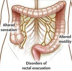 A chronic complex intestinal condition that causes inflammation in the digestive tract.