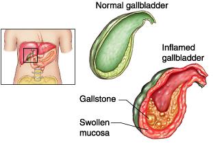 An inflammation of the gall bladder Causes & Risk Factors Symptoms Treatment Options