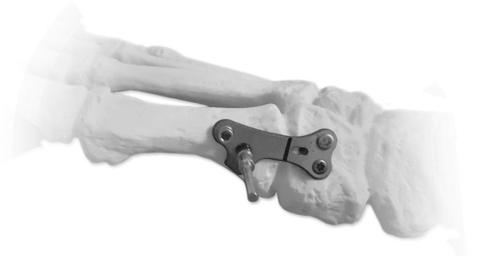 8. Place the interfragementary (IF) guide over the distal bone