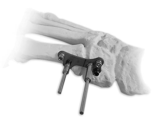 4. Load the compression clamp on the proximal tack pin and any one of the distal nubbins.