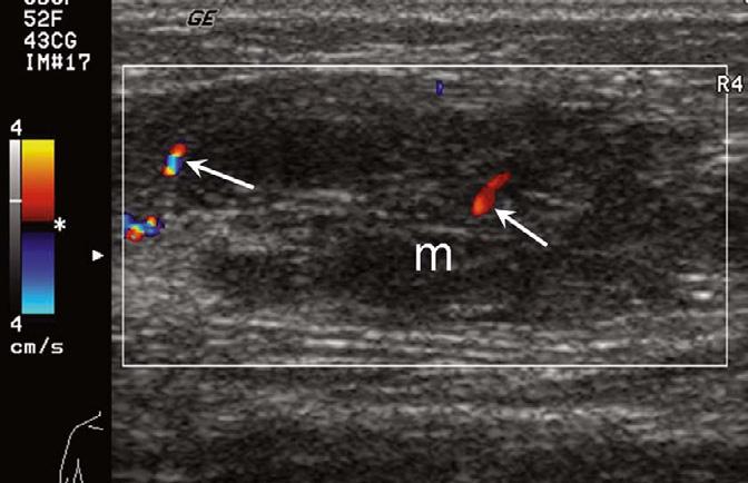 (B) Weak signal: longitudinal CDUS scanning of an intramuscular cavernous hemangioma (m) on right forearm. Note only a few spots of color Doppler signals (arrows) in the mass (m).