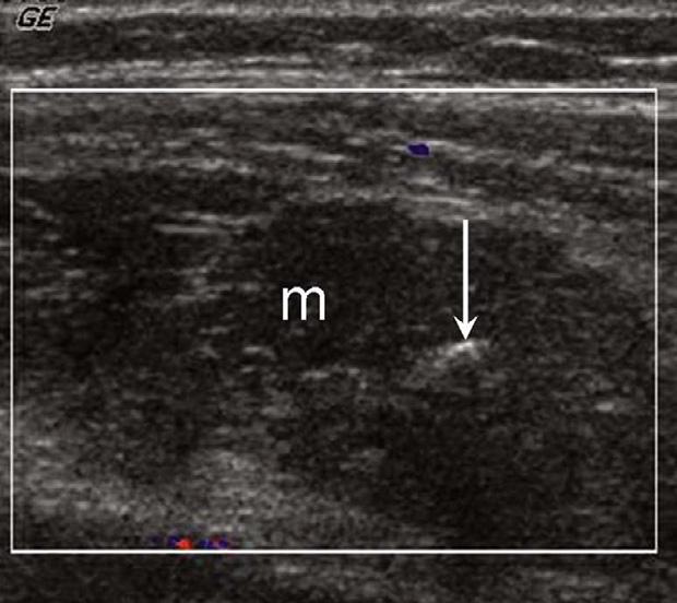 C.Y. Keng, H.H.C. Lan, C.C.C. Chen, et al A B Fig. 2. Longitudinal color Doppler ultrasound scan of an intramuscular cavernous hemangioma with color Doppler enhancing maneuver (CDEM).