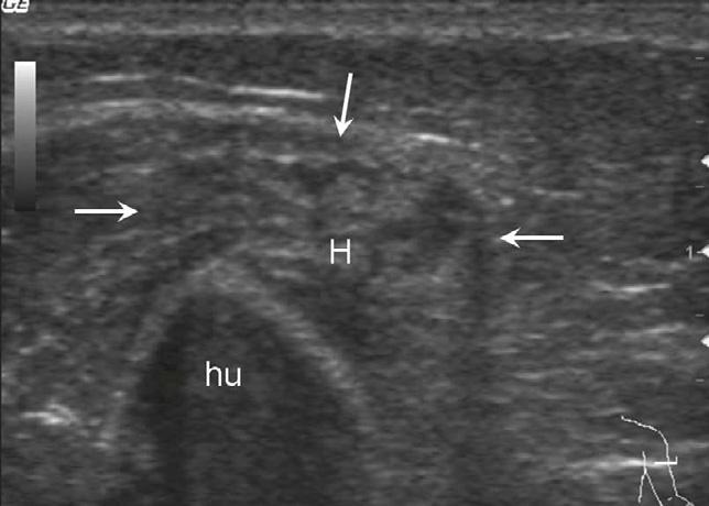 Ultrasonographic Features of Soft Tissue Hemangiomas A C B Fig. 3. High-resolution ultrasonography (HRUS) features of soft tissue hemangiomas.