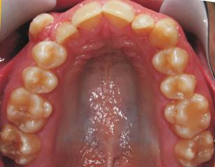 The mandibular right first molar had dental caries and hypocalcification was noted on