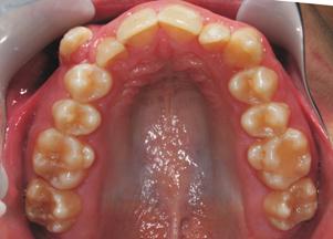 The maxillary and mandibular third molars were developing and the mandibular first