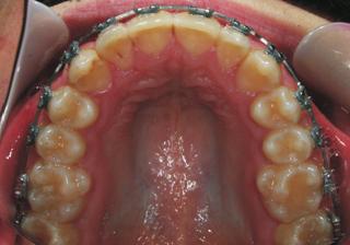 mandibular first premolars with short roots and protracting the mandibular