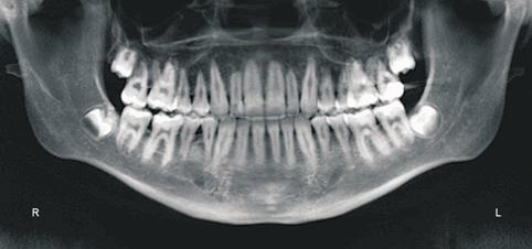 affect the patient s profile by retroclining the incisors.