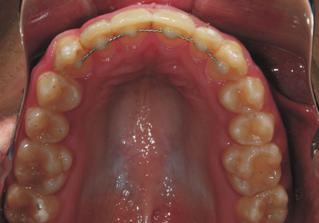 Extraction treatment of the maxillary first premolars and the mandibular