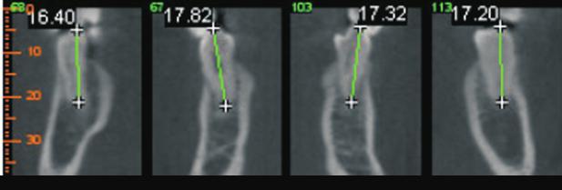 A. Pretreatment: mandibular right and left 1 st and 2 nd premolars B. Posttreatment: mandibular right and left 1 st and 2 nd premolars Figure 9. 3D measurements of the mandibular premolars.