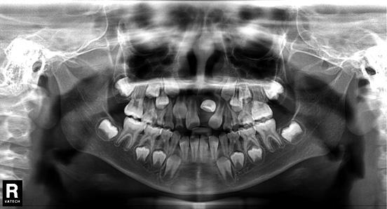A 2 x 3 fixed appliance (2 molar bands and 3 bonded incisors) was used initially to