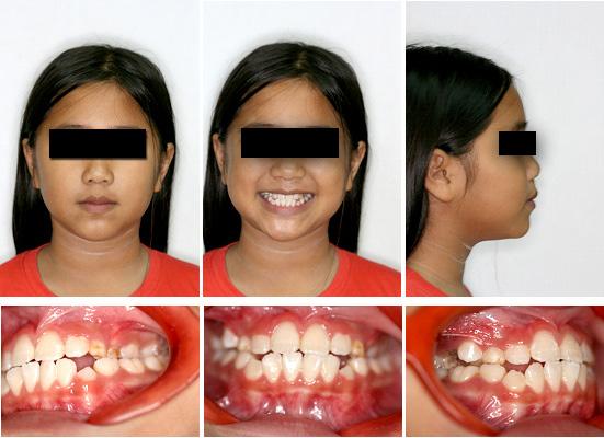 Figure 3 Post-treatment facial and intra-oral photographs Figure 4 Post-treatment panoramic radiograph Case 2 This case was a Thai boy, aged 14 years 8 months, whose mother was concerned about the