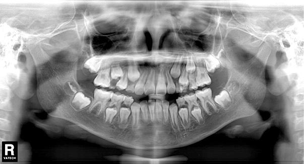The panoramic radiograph showed that two supernumerary teeth were related to delayed eruption of the maxillary right central incisor with dilacerations at the apical root (Fig. 5).
