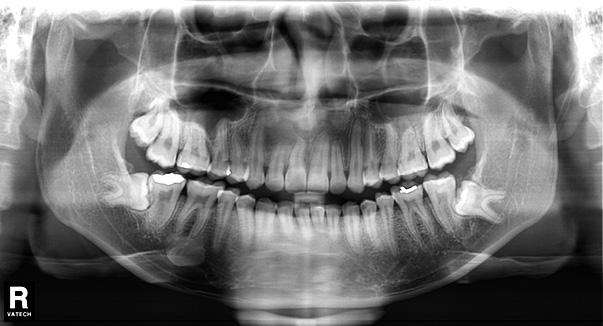 incisors Figure 8 Post-treatment