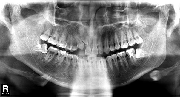 Case 3 A Lao male, aged 27 years 6 months was dissatisfied with non-eruption of his maxillary right lateral incisor and canine. He had wanted to have orthodontic treatment for many years.