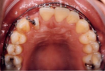 maxillary right lateral incisor exposed