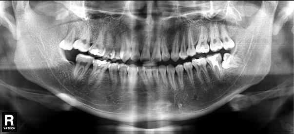 orthodontic traction Figure 13
