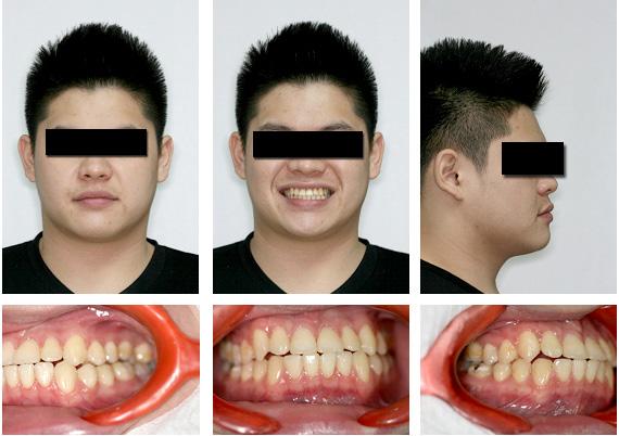 Figure 14 Post-treatment facial and intra-oral photographs Discussion Delayed eruption of the maxillary incisor can be a challenging problem, and treatment often requires orthodontics as well as