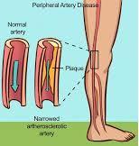 Poor Circulation (Peripheral Artery Disease): Introduction Poor circulations can make your foot less able