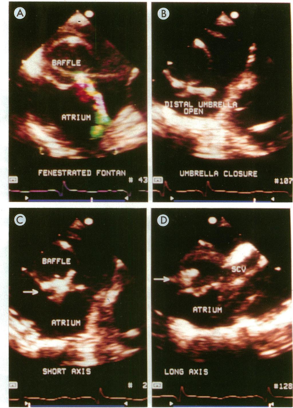 374 Redington, Rigby Br Heart J: first published as 10.1136/hrt.72.4.372 on 1 October 1994. Downloaded from http://heart.bmj.com/ Figure 2 Transoesophageal echocardiograms.