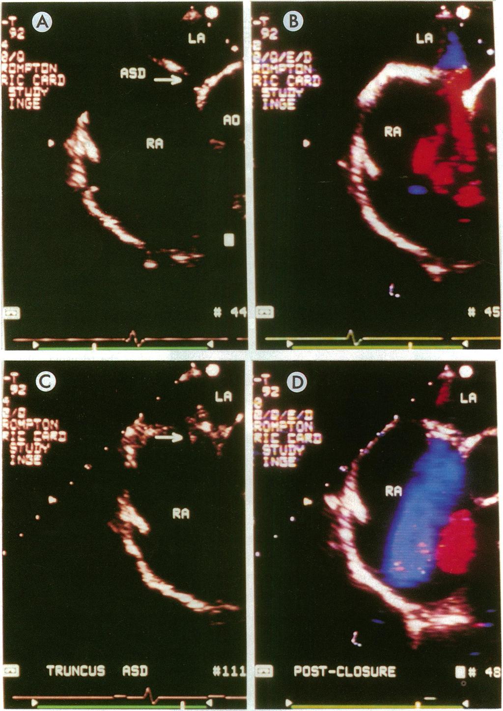 Transcatheter closure of interatrial communications with a modified umbrella device 375 Figure 3 Transoesophageal echocardiograms (A) A secundum atrial septal defect after repair of common arterial