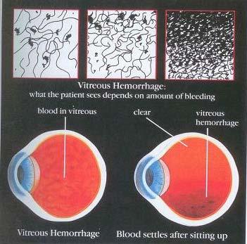 Vitreous Hemorrhage Symptoms Because vitreous hemorrhage is not necessarily associated with any specific activity (although it can be associated with strenuous physical activity), people with