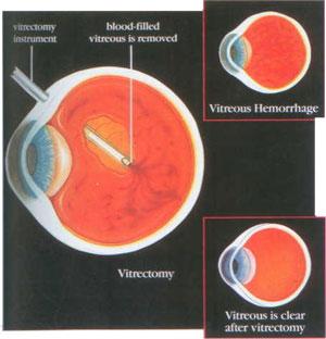 Vitreous Hemorrhage If there is so much vitreous hemorrhage that laser surgery is not possible, or if the blood does not disappear on its own, it can be removed with an operation called a Vitrectomy.