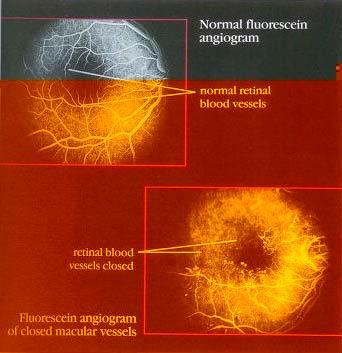 Closure of Macular Vessels DIABETIC RETINOPATHY If the retinal blood vessels in the macula close, the macula stops working. This causes loss of central or detail vision.