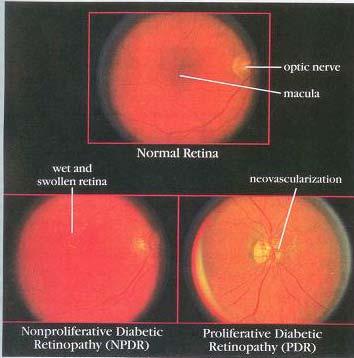 Two Kinds of Diabetic Retinopathy DIABETIC RETINOPATHY In diabetic retinopathy the blood vessels of the retina become abnormal and cause the problems that people with diabetes have with their