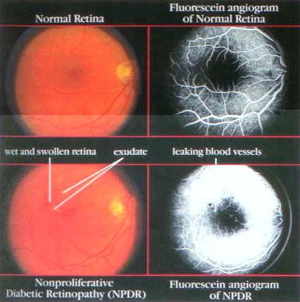 Nonproliferative (Background) Diabetic Retinopathy (NPDR) In diabetes, the retinal blood vessels can develop tiny leaks.