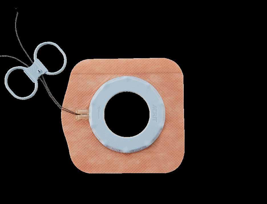 Our securement devices hold catheters in place without the use of