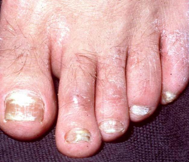 TINEA UNGUIUM - BACKGROUND Onychomycosis is a chronic fungal infection of the