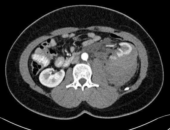 Slika 1: CT arterijska faza: