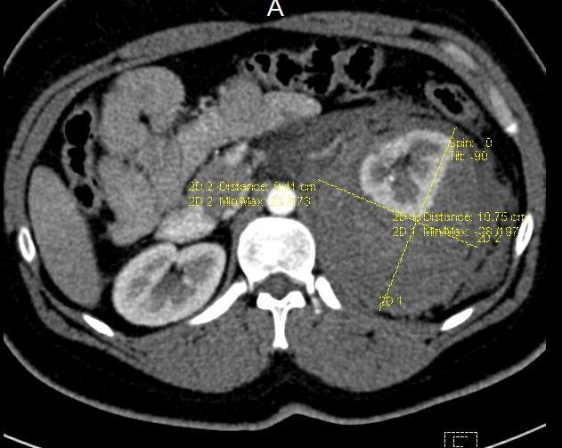 Slika 3: CT arterijska faza: velikost