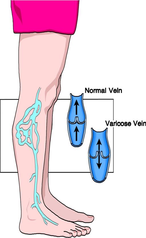For the personal patients of Bruce Braithwaite V11 Endovenous Ablation What are varicose veins? Varicose veins are enlarged and twisted veins in the leg.