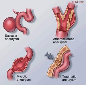 Appendices Appendix 1: Types and Locations of Intracranial Aneurysms From the Barrow Neurological Institute; available at: http://www.thebni.