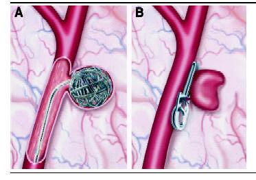 Appendix 2: Illustration of Coil Embolization and Surgical Clipping of Intracranial Aneurysm A. Coil Embolization B.