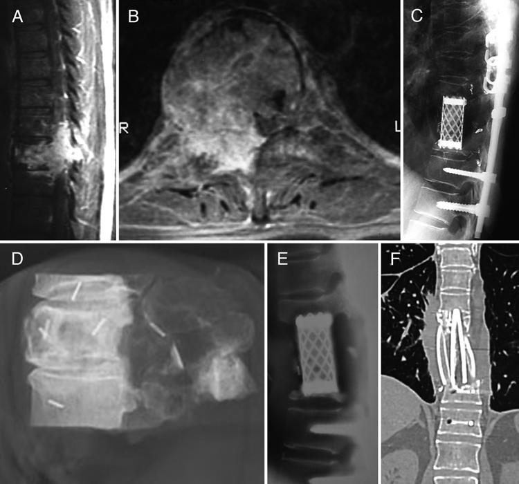 M. Matsumoto et al. Fig. 1. Case 1. Images obtained in a 42-year-old man with a thyroid cancer metastasis at T-8 to T-10.