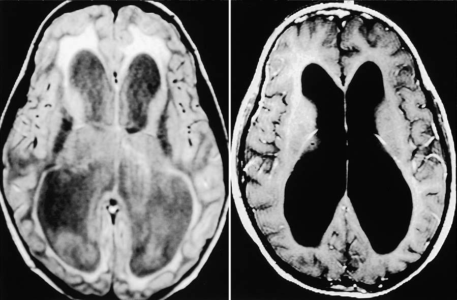 W. J. Hader, et al. FIG. 1. Case 1. Left: Axial fluid-attenuated inversion-recovery MR image demonstrating enlargement of lateral ventricles with surrounding periventricular edema.