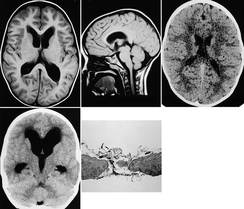 Death after late failure of third ventriculostomy FIG. 2. Case 2. Upper Left: Admission axial T 1 -weighted MR image demonstrating enlarged lateral and third ventricles.
