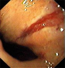 Mucosal Tear (Mallory Weiss) Mallory-Weiss tears present in a classic pattern ( Emesis followed by Haematemesis ) 90% of