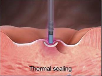 CONTACT THERMAL THERAPY http://www.