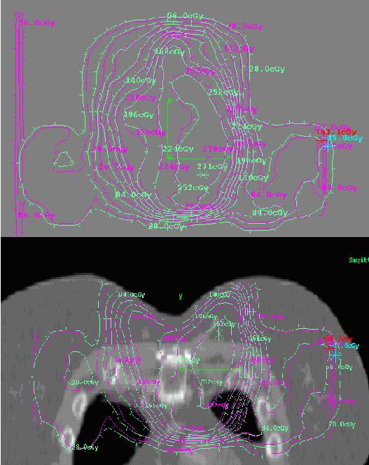 Again, from figures 6.38 & 6.39 both show Dosimetry Check and MapCheck to be comparable to the TPS. For the lung IMRT plans, measurements were taken at 5cm depth. Figures 6.40 & 6.