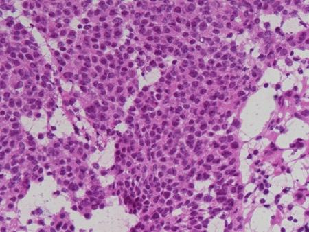 10 Frozen Section Library: Head and Neck For the small blue cell tumors, there are overlapping histologic features. Most of the time, immunostains are needed to separate them.