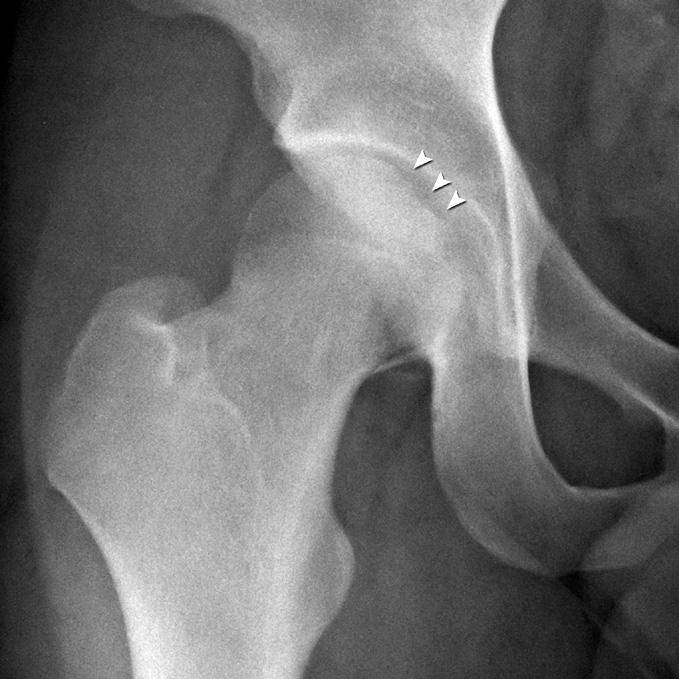 337 osteochondral indentation at the superomedial portion of the femoral head.