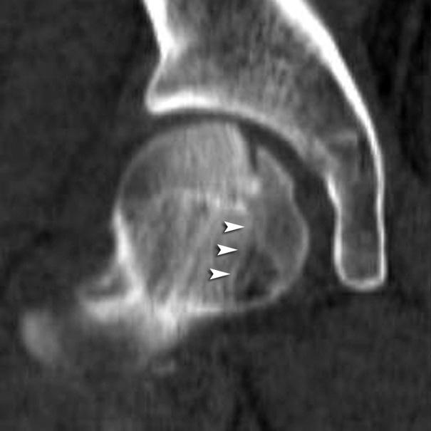 The fracture line extended to the inferior portion of the femoral head with bone marrow edema (Figs. 4A and 5A). The patient was admitted and remained in bed for 2 weeks.
