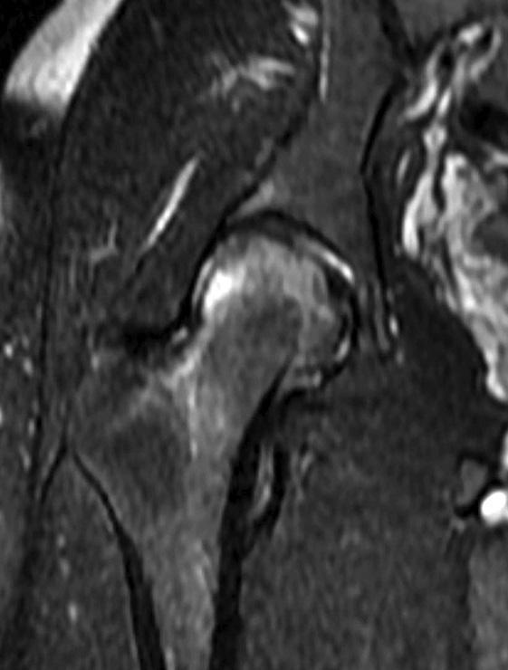 line extended to the inferior portion of the femoral head with bone marrow edema.