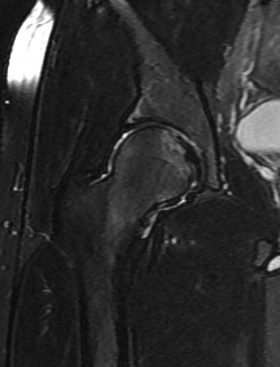 Final follow-up MRI (C) showed a completely healed femoral head fracture. Fig. 5.